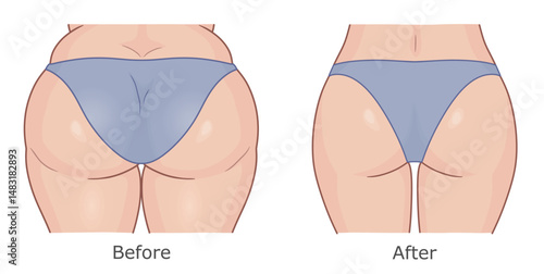 Women's butt and thighs in panties before and after weight loss. Vector illustration.