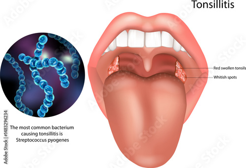 The image also highlights Streptococcus pyogenes, the most common bacterium responsible for bacterial tonsillitis. 
