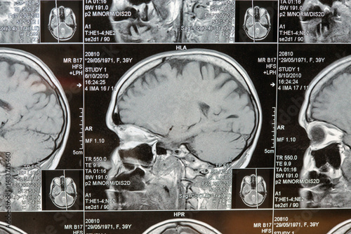 Magnetic resonance imaging or MRI image of the brain