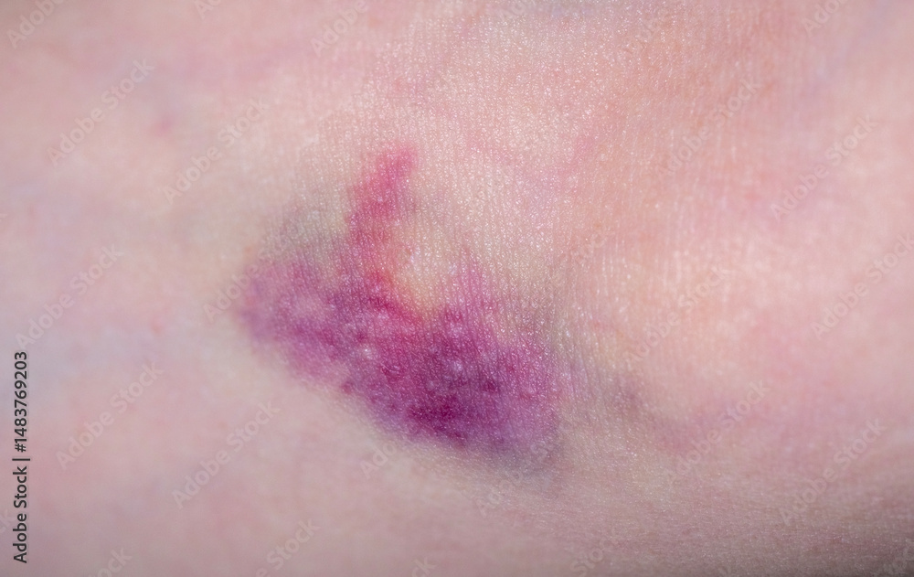 Fototapeta premium bruise on female hand skin, hematoma on elbow area from blood draw, hurt mark, medical treatment, symptom medical condition, body pain, Health care