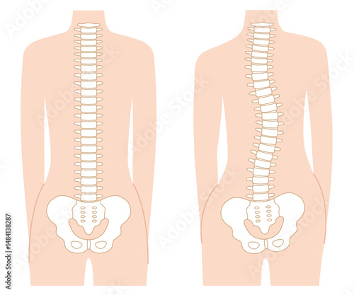 背骨の歪み　正常な背骨　