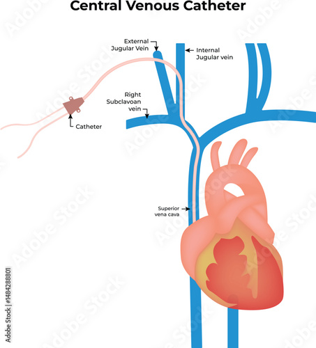 Central Venous Catheter Placement Anatomy Diagram