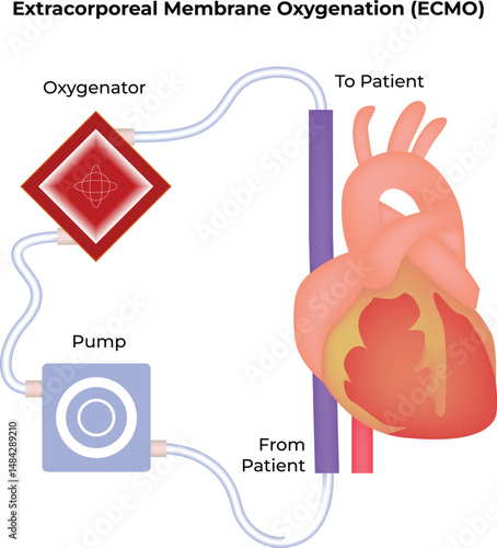 Extracorporeal Membrane Oxygenation ECMO System Diagram