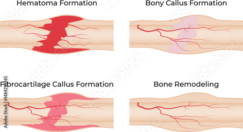 Stages of Bone Fracture Healing Hematoma Callus Formation and Remodeling