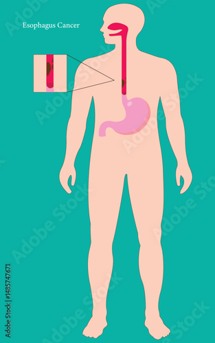 Medical illustration of esophageal cancer inside human body, anatomy and disease concept