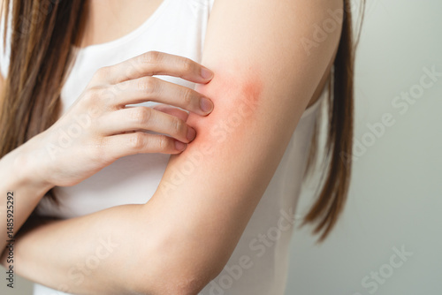 Wallpaper Mural Sensitive skin allergic concept, Woman itching on her arm have a red rash from allergy symptom and from scratching. Torontodigital.ca