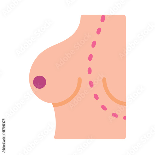 Breast augmentation surgery preparation with incision dotted lines illustration