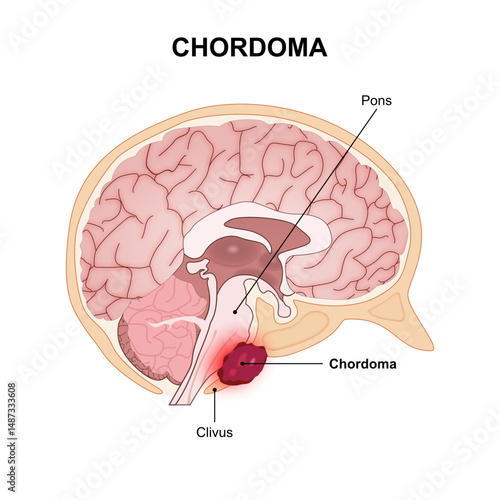 Chordoma Tumor in Brain Illustration