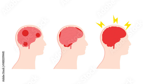 Human brain hemorrhage disease sign vector illustration collection for use.