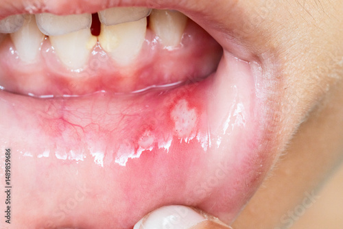 Schilderij op canvas Aphthous stomatitis affecting inner lip of young child: symptoms and treatment