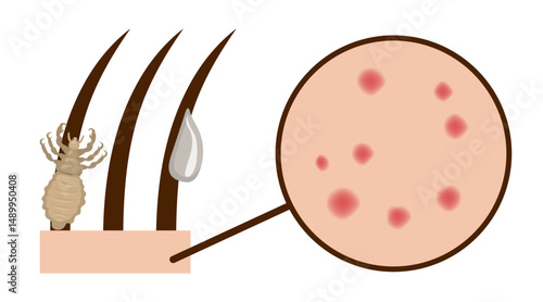 Head louse clinging to hair and causing itchy rash