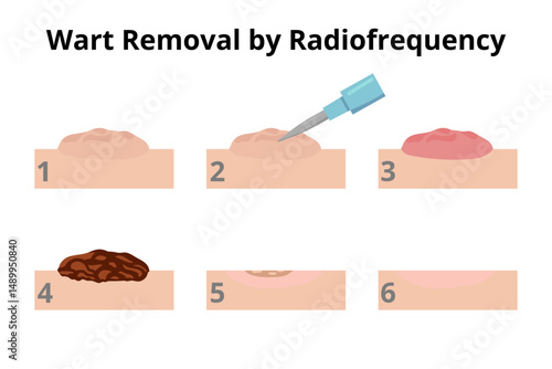 Wart removal by radiofrequency surgery, medical infographic