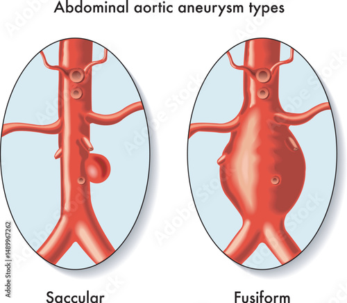 Medical illustration of Abdominal aortic aneurysm types, with annotations