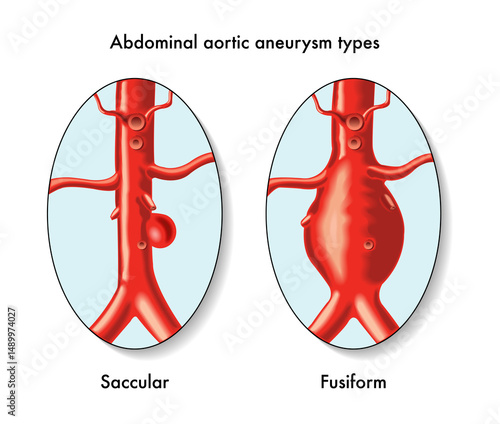Medical illustration of Abdominal aortic aneurysm types, with annotations