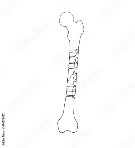 femur internal fixation