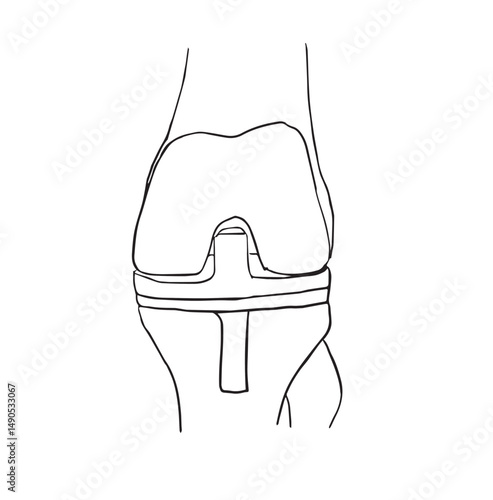 total knee replacement