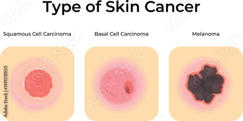 Types of Skin Cancer Squamous Basal Cell and Melanoma