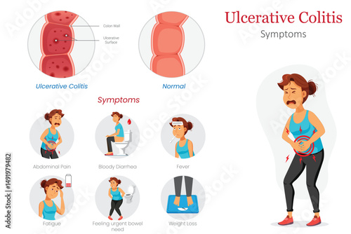 Healthy vs Ulcerative Colitis Intestine Diagram Showing Symptoms