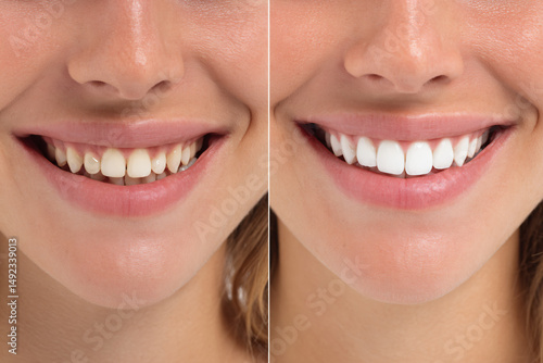 Witness the stunning transformation from dull to brilliantly white teeth.