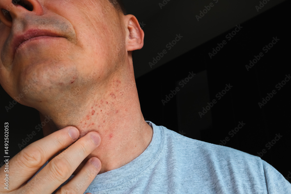 Fototapeta premium Skin irritation after shaving. Skin irritation on male neck after shaving. Close-up photo.