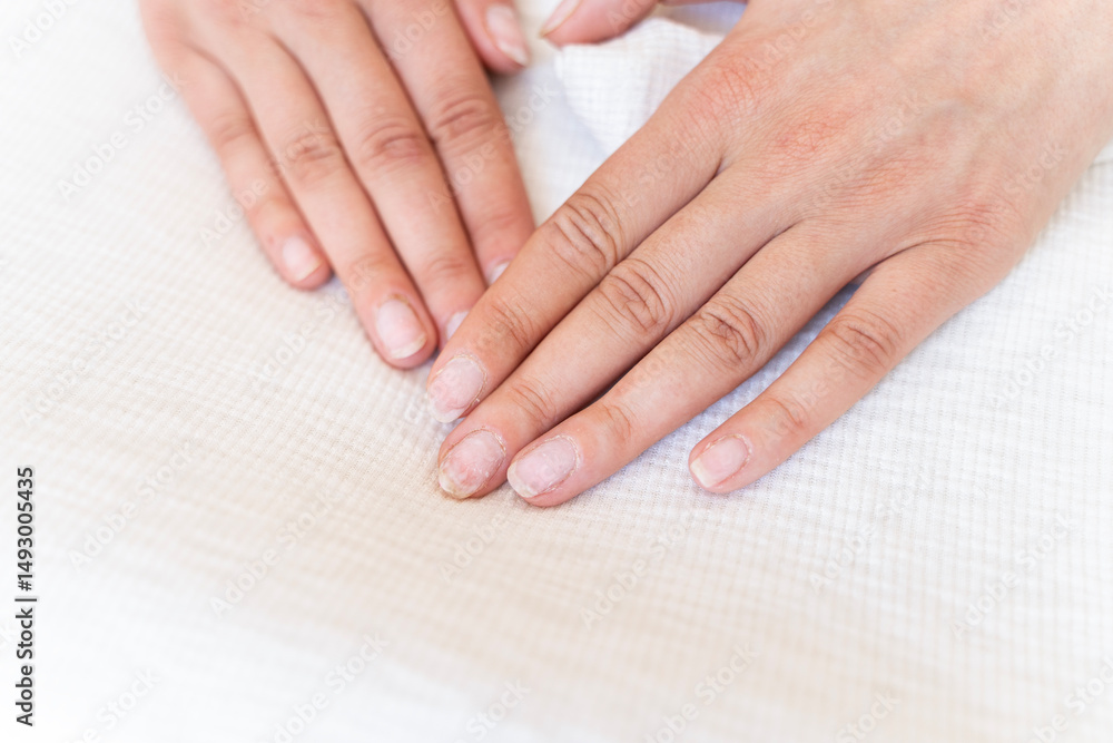 Fototapeta premium Damaged fingernails from gel polish. Hand care. Nail health. Free space.