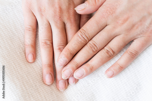 Damaged fingernails from gel polish. Hand care. Nail health. Free space.