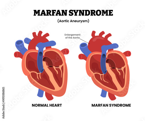 Heart Marfan Syndrome, educational medical poster design healthcare scheme, internal organs, cardiovascular disease, heart complication. Labeled bulge or enlargement of aorta enlarged. Aortic aneurysm