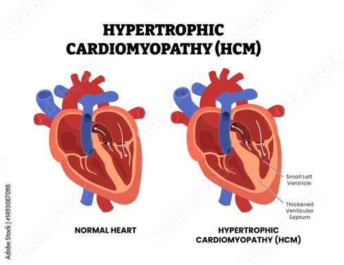 Heart Hypertrophic Cardiomyopathy (HCM), educational medical poster design healthcare scheme, internal organs, cardiovascular disease, heart complication.Labeled small left ventricle, thickened septum