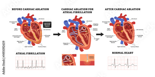 Before and after cardiac ablation for heart atrial fibrillation, educational medical poster design healthcare scheme, internal organs. Labeled ablation catheter, regular irregular heartbeat rhythm ECG