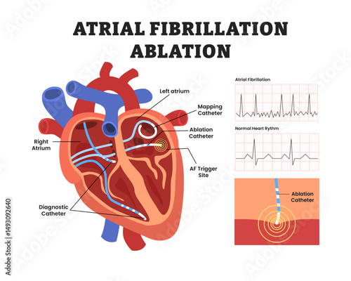 Cardiac ablation for heart atrial fibrillation, educational medical poster design healthcare scheme, internal organs. Labeled ablation catheter ablation, regular irregular heartbeat rhythm ECG.