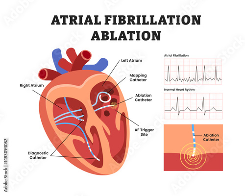 Cardiac ablation for heart atrial fibrillation, educational medical poster design healthcare scheme, internal organs. Labeled ablation catheter ablation, regular irregular heartbeat rhythm ECG.