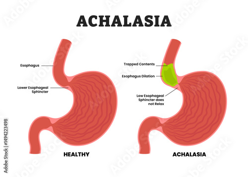 Achalasia stomach disease, educational medical poster design healthcare scheme, human stomach internal organs. Labeled esophagus dilation, esophageal sphincter does not relax.