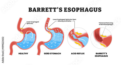 Barrett's Esophagus Stomach Disease or Metaplasia, educational medical poster design healthcare scheme, human stomach internal organs. Labeled thickened red lining esophagus. GERD, acid reflux.