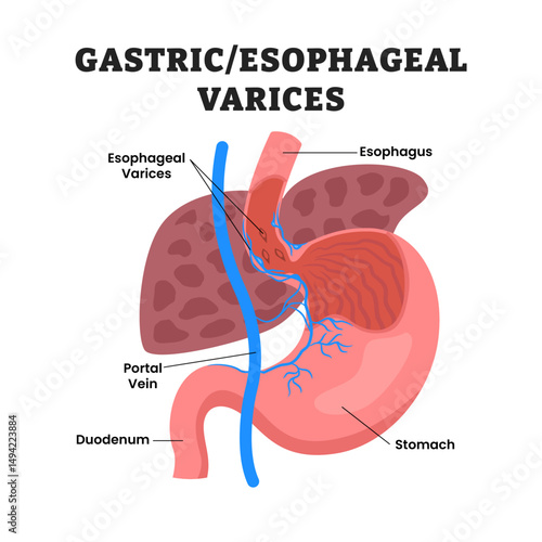 Gastric Varices educational medical poster design healthcare scheme, human stomach internal organs. Labeled Esophageal Varices, esophagus, duodenum, portal vein, pancreas.