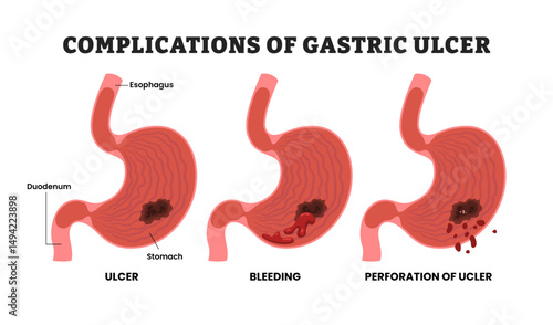 Different types of Gastric Ulcer Complications, educational medical poster design healthcare scheme, human stomach internal organs. Labeled ulcer, bleeding, perforation, esophagus, duodenum.