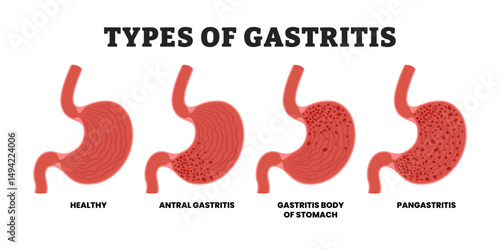 Different types of gastritis types, educational medical poster design healthcare scheme, human stomach internal organs. Labeled inflammation, antral gastritis, pangastritis, gastritis stomach body. 