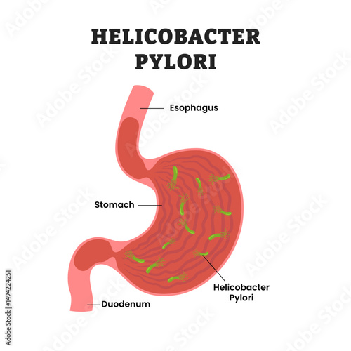 Helicobacter Pylori Stomach Disease, educational medical poster design healthcare scheme, human stomach internal organs. Labeled esophagus, duodenum, bacterial, virus, microbe.