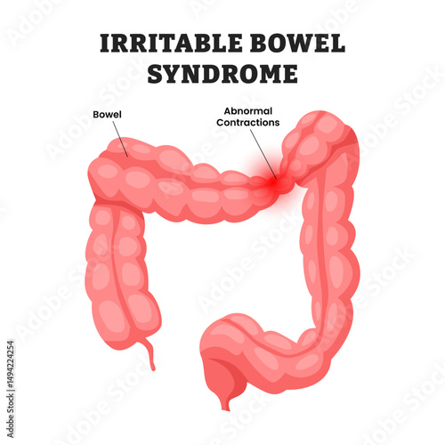 Irritable Bowel Syndrome, educational medical poster design healthcare scheme, human stomach internal organs. Labeled gastrointestinal disorder, colon, intestinal, large intestine.