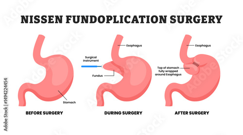 Before After Nissen Fundoplication Surgery Procedure, educational medical poster design healthcare scheme, human stomach internal organs. Labeled Lap Nissen, fundus, anti GERD treatment.