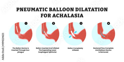 Pneumatic Balloon Dilatation for Achalasia Procedure Steps, Stomach Disease, educational medical poster design healthcare scheme, human stomach internal organs. Labeled Inflated Balloon, esophageal.