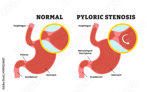 Normal VS Pyloric Stenosis Stomach Disease, educational medical poster design healthcare scheme, human stomach internal organs. Labeled narrow pylorus, esophagus, duodenum, Gastroparesis.