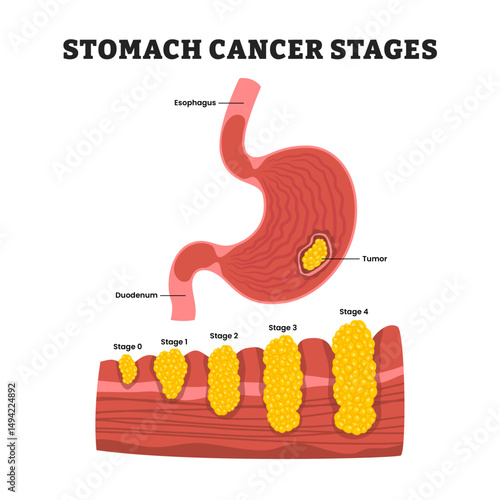 Stomach cancer stages diagram process or progression, educational medical poster design healthcare scheme, human stomach internal organs. Labeled tumor, gastric cancer, duodenum, esophagus.