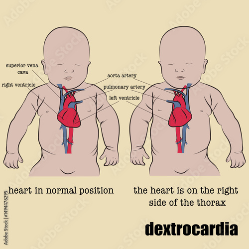 Dextrocardia is a congenital condition in which the heart is inverted from its natural position.
