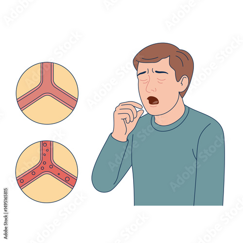 Medical poster with bronchitis diagram and patient. Man coughing. Disease infographic. Medical vector illustration