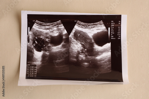 Tableau sur toile 2D ultrasound photo of a woman's uterus with a cyst