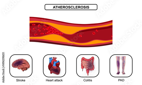 Atherosclerosis, myocardial and mesenteric ischemia, cerebral stroke and peripheral arterial disease. blood vessel blockage, plaque, infarction and thrombosis. Vector illustration for medical poster