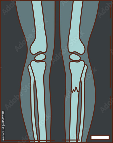 Cartoon groovy xray scan showing human leg bones, with a visible fracture on one side. medicine and human body medical vector icon represents radiology, bone health, injury diagnosis, and healthcare