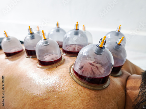 Obraz na płótnie Wet cupping therapy (Hijama) on a man's back,
