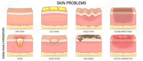 Structure of oily skin. Comparison of normal and oily skin. Facial skin problems. Vector for advertising about beauty and medical treatment.