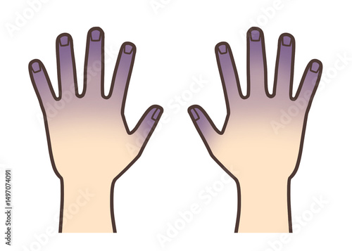 疾患の兆候、末梢性チアノーゼによる指先の紫色の変色